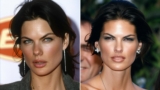 Before and After Celebrities With Fillers