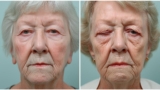 Blepharoplasty Celebrity Before and After