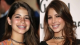 Braces Before and After Celebrities