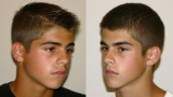 Celebrity Hair Transplant Before and After